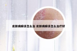 皮肤病癣该怎么治 皮肤病癣该怎么治疗好