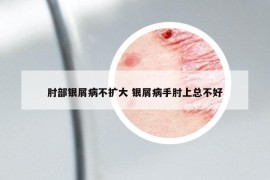 肘部银屑病不扩大 银屑病手肘上总不好