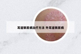 耳道银屑病治疗方法 外耳道银屑病
