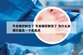 牛皮癣控制住了 牛皮癣控制住了 为什么会偶尔蹦出一个出血点