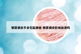 银屑病会不会引起静脉 银屑病会影响血液吗