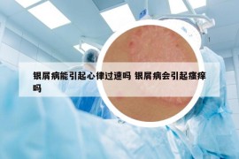 银屑病能引起心律过速吗 银屑病会引起瘙痒吗