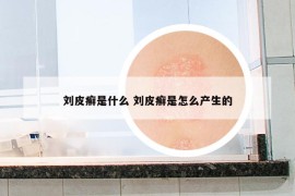 刘皮癣是什么 刘皮癣是怎么产生的