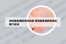 郑州银屑病研究所在哪 郑州银屑病研究所在哪个区域