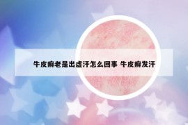 牛皮癣老是出虚汗怎么回事 牛皮癣发汗