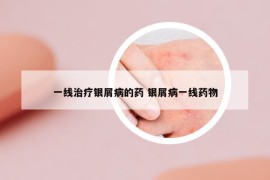 一线治疗银屑病的药 银屑病一线药物