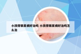 小孩得银屑病好治吗 小孩得银屑病好治吗怎么治
