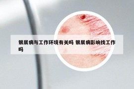 银屑病与工作环境有关吗 银屑病影响找工作吗
