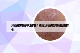 济南银屑病哪治的好 山东济南银屑病医院排名