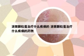 消银颗粒是治疗什么疾病的 消银颗粒是治疗什么疾病的药物