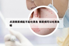 点滴银屑病能不能吃黑鱼 银屑病可以吃黑鱼嘛
