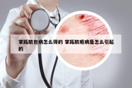 掌跖脓包病怎么得的 掌跖脓疱病是怎么引起的