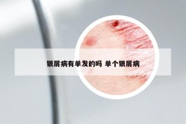 银屑病有单发的吗 单个银屑病