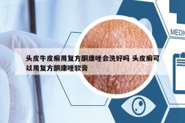 头皮牛皮癣用复方酮康唑会洗好吗 头皮癣可以用复方酮康唑软膏