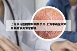 上海中山医院银屑病关节炎 上海中山医院银屑病关节炎专家排名