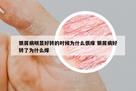 银屑病明显好转的时候为什么很痒 银屑病好转了为什么痒