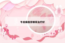 牛皮癣南京哪家治疗好