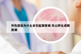 外伤感染为什么会引起银屑病 伤口转化成银屑病