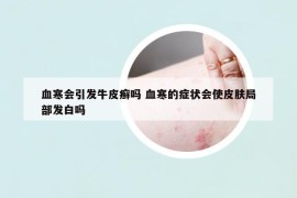 血寒会引发牛皮癣吗 血寒的症状会使皮肤局部发白吗