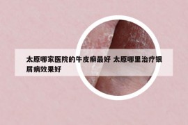 太原哪家医院的牛皮癣最好 太原哪里治疗银屑病效果好