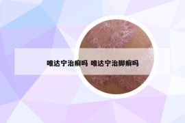 唯达宁治癣吗 唯达宁治脚癣吗
