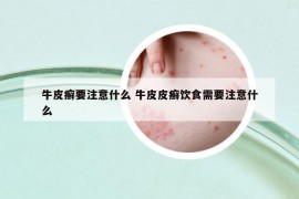 牛皮癣要注意什么 牛皮皮癣饮食需要注意什么
