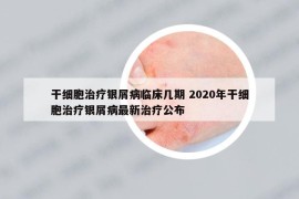干细胞治疗银屑病临床几期 2020年干细胞治疗银屑病最新治疗公布