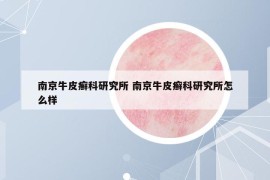 南京牛皮癣科研究所 南京牛皮癣科研究所怎么样