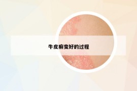 牛皮癣变好的过程