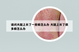请问大腿上长了一些癣怎么办 大腿上长了很多癣怎么办