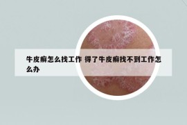 牛皮癣怎么找工作 得了牛皮癣找不到工作怎么办