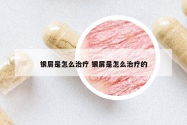 银屑是怎么治疗 银屑是怎么治疗的