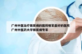 广州中医治疗银屑病的医院哪家最好的医院 广州中医药大学银屑病专家