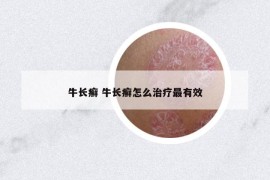 牛长癣 牛长癣怎么治疗最有效