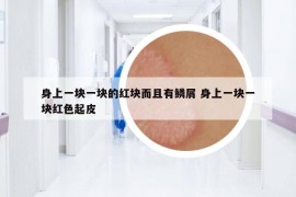 身上一块一块的红块而且有鳞屑 身上一块一块红色起皮