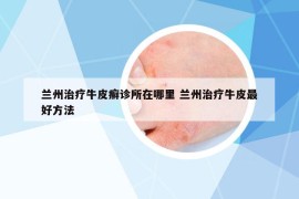 兰州治疗牛皮癣诊所在哪里 兰州治疗牛皮最好方法
