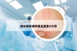 烟台银屑病可是孟晨星A力荐