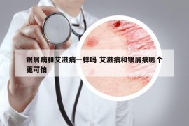银屑病和艾滋病一样吗 艾滋病和银屑病哪个更可怕