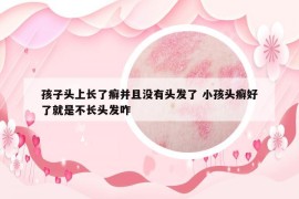 孩子头上长了癣并且没有头发了 小孩头癣好了就是不长头发咋
