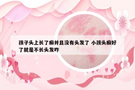 孩子头上长了癣并且没有头发了 小孩头癣好了就是不长头发咋