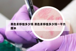 黑色素移植多少钱 黑色素移植多少钱一平方厘米