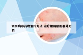 银屑病非药物治疗方法 治疗银屑病的非处方药