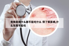 有银屑病什么都不能吃什么 得了银屑病,什么东西不能吃