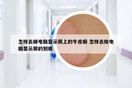 怎样去掉电脑显示屏上的牛皮癣 怎样去除电脑显示屏的划痕