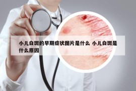 小儿白斑的早期症状图片是什么 小儿白斑是什么原因