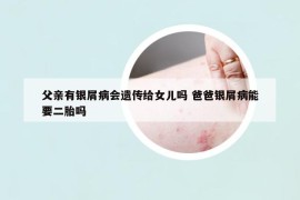 父亲有银屑病会遗传给女儿吗 爸爸银屑病能要二胎吗