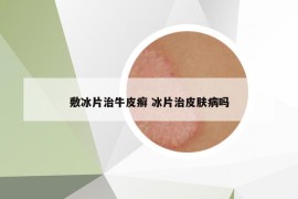 敷冰片治牛皮癣 冰片治皮肤病吗