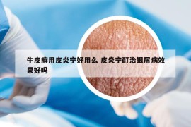 牛皮癣用皮炎宁好用么 皮炎宁酊治银屑病效果好吗