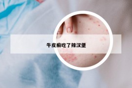 牛皮癣吃了辣汉堡