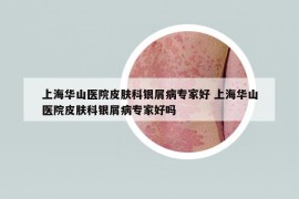 上海华山医院皮肤科银屑病专家好 上海华山医院皮肤科银屑病专家好吗